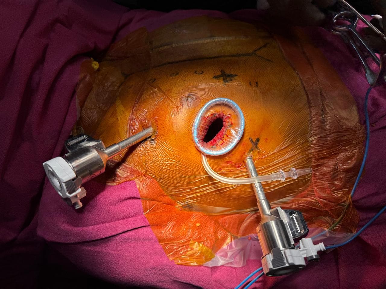 Dr. Nisarga — surgical team in action