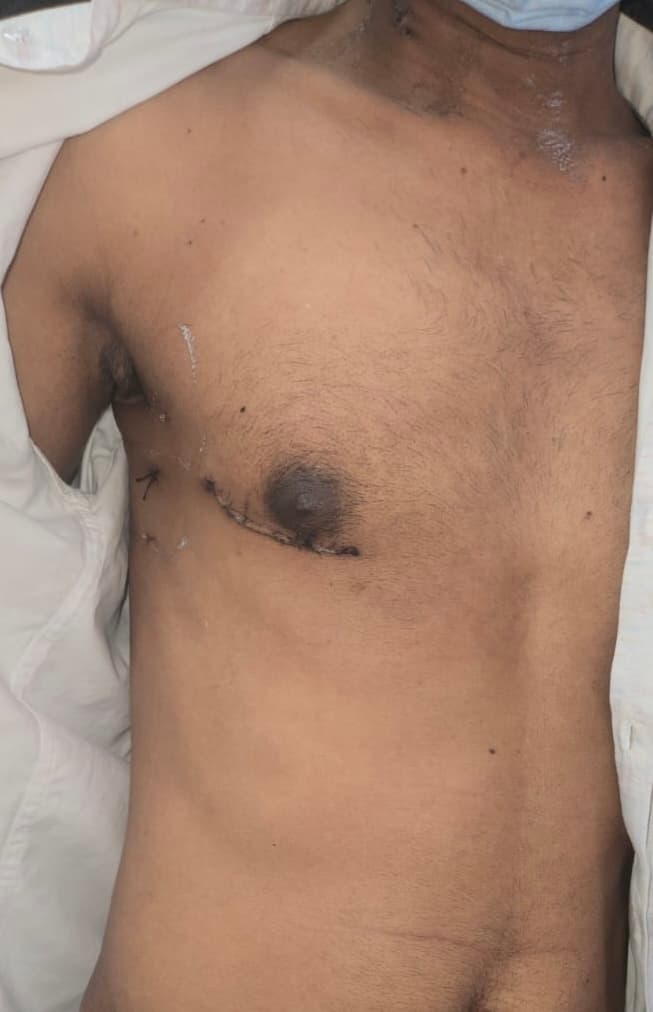 Robotic cardiac surgery incisions - small keyhole incisions