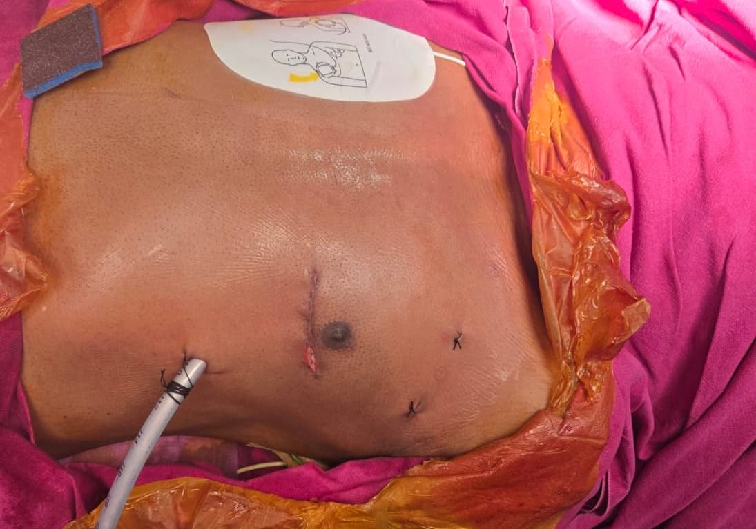 Robotic surgery scar healing result