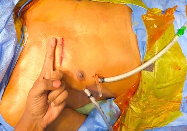 Healed robotic heart surgery incisions