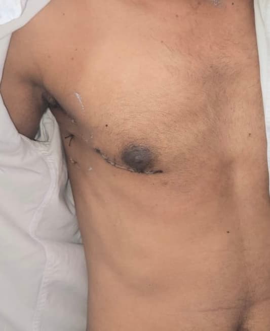 MICS incision result after cardiac surgery