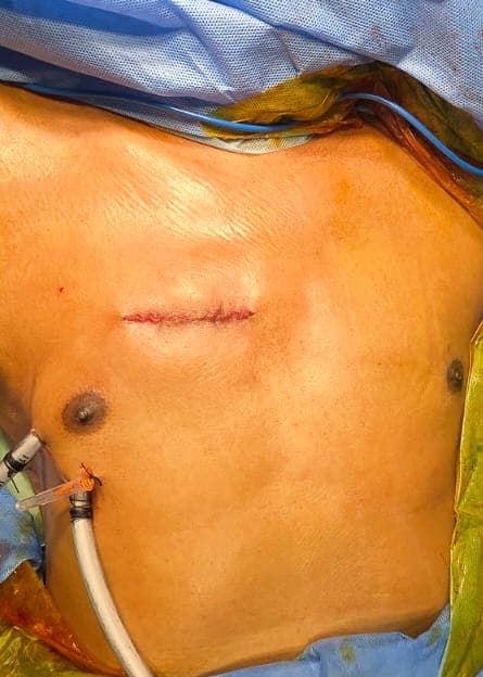Minimally invasive cardiac surgery scar outcome